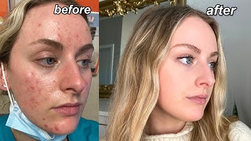 MY ACCUTANE JOURNEY | my acne experience, Q&A, tips, + pictures