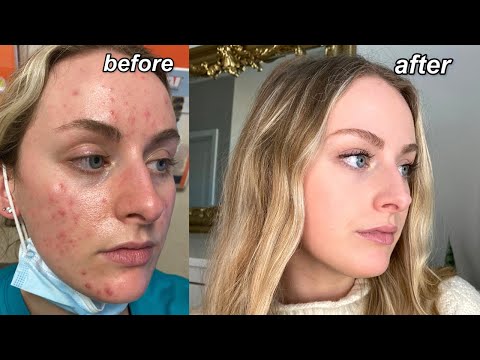 MY ACCUTANE JOURNEY