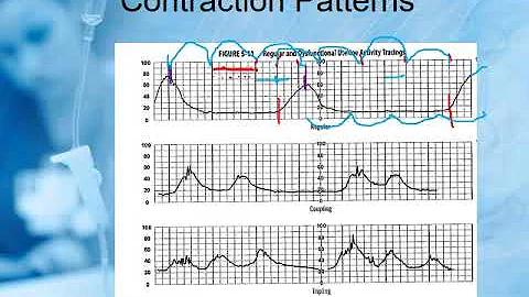 Fetal Monitoring August 2018