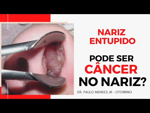 Cancer no nariz: Quais os sintomas e como fazer o diagnóstico?