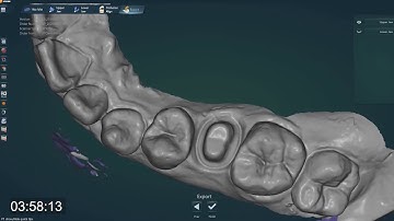 Dental impression scan with wax bite in UP300+