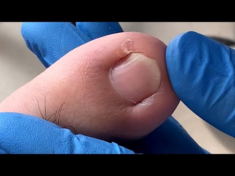 วีดีโอ: 3 วิธีในการรักษา Paronychia