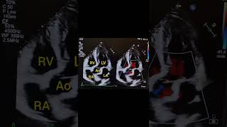 Apical Five Chamber (A5C) View with Color Flow Doppler. #echocardiography #echo