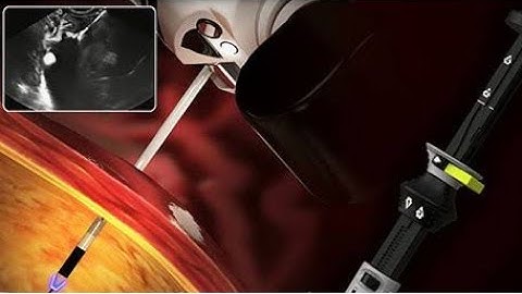 HOW TO DEPLOY  HOT AXIOS STENT EUS-guided drainage  pseudocyst Hot AXIOS stent Step by Step