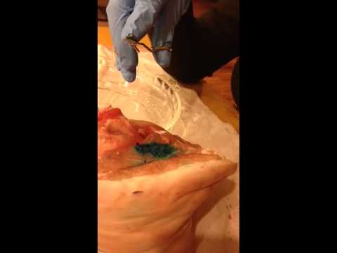 Debridement necrotic tissue
