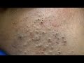 Korean Blackhead Removal | Deep Facial Cleansing & Skincare Routine