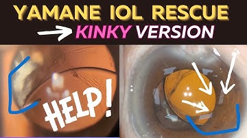 Complicated IOL Rescue - Yamane Lessons Learned with ZA9003 Lens, Small Eye, Floppy Iris, Glaucoma