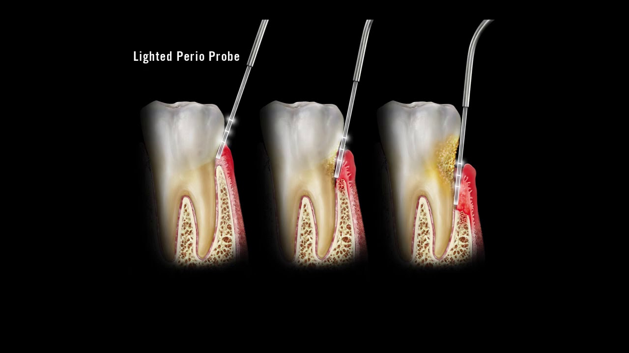 te presenta el sistema de diagnóstico Microlux-AdDent