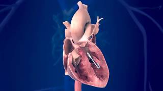 Swan-Ganz Catheter Placement Medical Animation - Infuse Medical