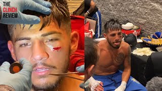 NASTY CUT! TONY AGUILAR GETS STITCHED UP MOMENTS AFTER BIG WIN AGAINST ALEXANDER RIOS IN REMATCH