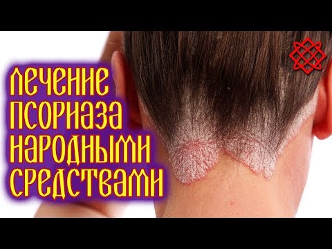 PSORIASIS TREATMENT AT HOME. How to Cure Psoriasis Quickly and Easily