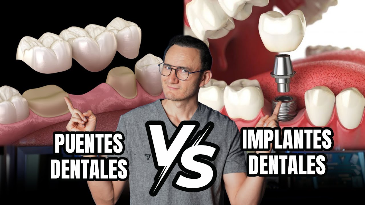 PUENTE VS IMPLANTE DENTAL | La verdad que pocos te cuentan.