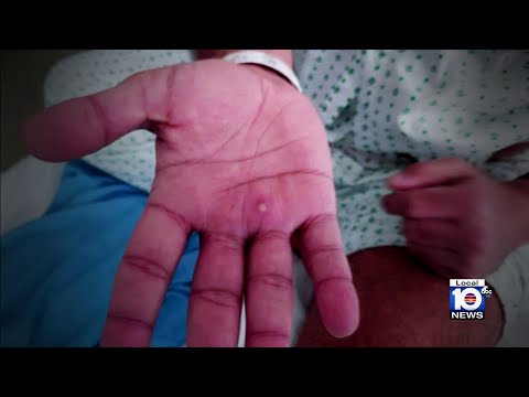 More vaccines available as cases of monkeypox continue to rise