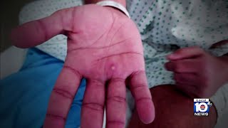 Vaccines are ready to go as monkeypox cases continue to rise.