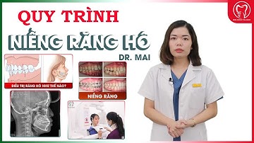 Các bước niềng răng hô tại Nha khoa Italiano Thái Nguyên