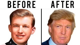 Donald Trump's Hair Transplant | Plastic Surgery Analysis