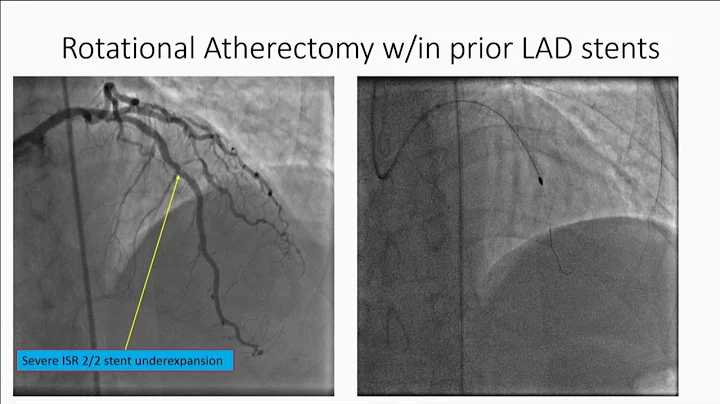 How to Treat Large Vessel Coronary Perforation - M...