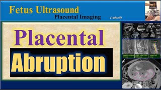 Fetus Ultrasound , Placental Abruption