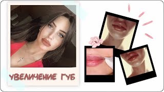 УВЕЛИЧЕНИЕ ГУБ ГИАЛУРОНОВОЙ КИСЛОТОЙ || РЕАКЦИЯ РОДИТЕЛЕЙ || МОЙ ОПЫТ УВЕЛИЧЕНИЕ ГУБ ГИАЛУРОНОВОЙ КИСЛОТОЙ || РЕАКЦИЯ РОДИТЕЛЕЙ || МОЙ ОПЫТ