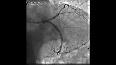 Complex PCI for LCX ostial lesion video 11