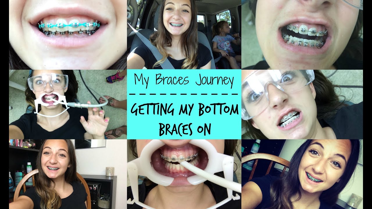 my braces journey