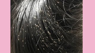 التخلص من حشرات الشعر (القمل/الصيبان )عند الأطفال للأبد من أول أستعمال .
