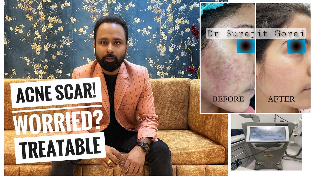 Most advanced treatment for Acne scar in Kolkata YouTube