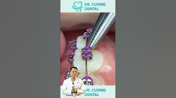 Quy trình niềng răng | Dr Cường Offical #drcuong #shorts