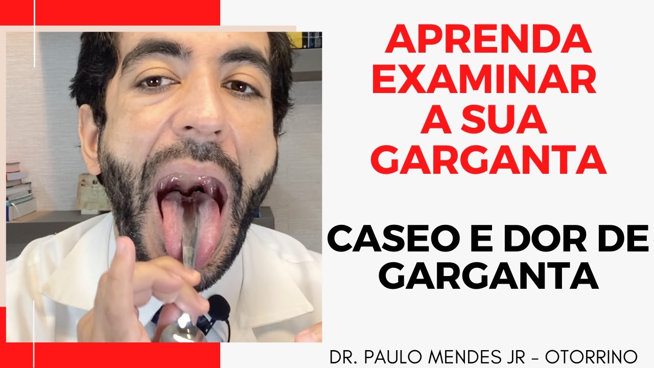 CASEUM: AS MASSINHAS FEDORENTAS DA GARGANTA – Clínica Rhinus