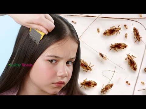 How to Get Rid of Head Lice Fast and Easy | Health and Beauty