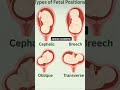 TYPES OF FETAL POSITION. ..... ##SHORTVIDEO #SUBSCRIBE #MEDICALSTUDENTS #TRENDINGSHORTS #likeforlik