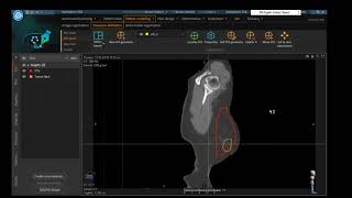 3D-Breast planning With-without Wedges