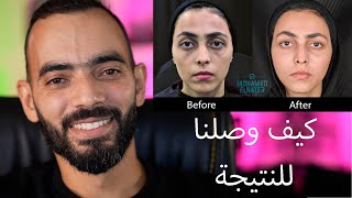 ليزر + فيلر  Makeover 2