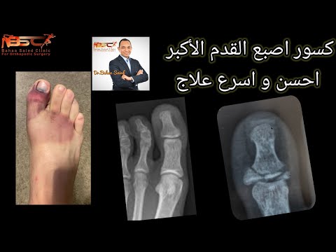 كسور و تورم اصبع القدم الاكبر اسرع علاج