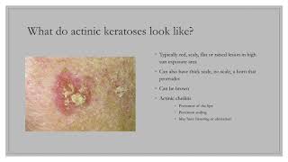 Kaitlin Vaughn, PA - Actinic Keratoses (AKs)