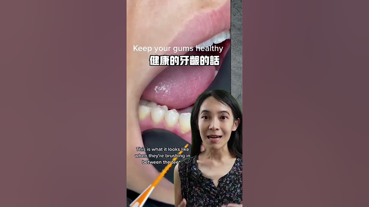 洗牙流很多血是醫生手不巧嗎#洗牙結石#牙周病#牙齦炎