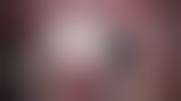 Excision of Ocular Surface Squamous Cell Neoplasia (OSSN) and Reconstruction