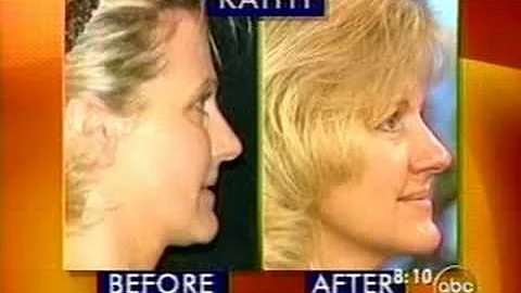 Dr.Michelle Copeland Non Surgical Facelift