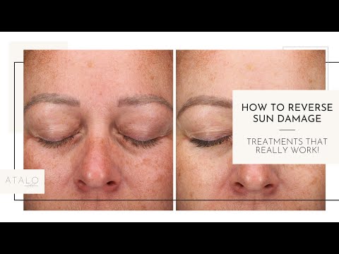 Video: Emergency Measures: How To Restore Skin After Sun