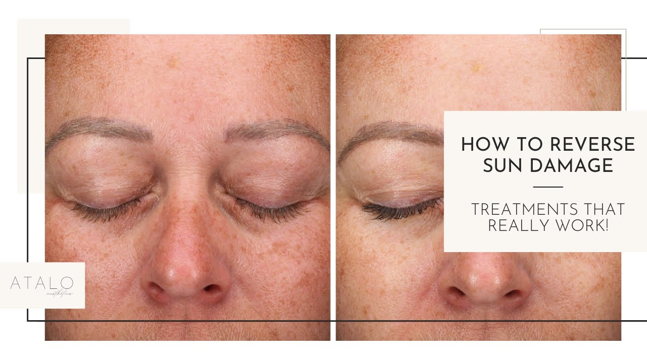 How To Reverse Sun Damage - YouTube