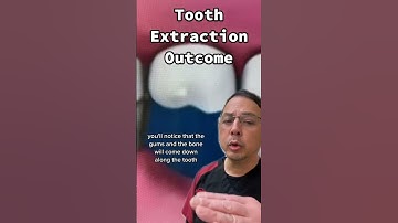 Consequences of NOT Replacing Missing Teeth | In Office to Hands On Dental Training