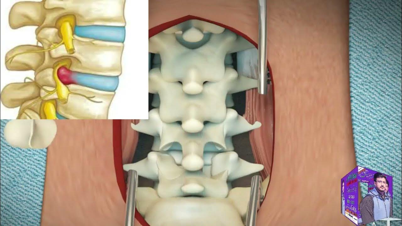 disc slip ,disc prolapse ,disc surgery animation in Urdu/hindi by dr