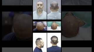 PRGF for Hair Loss | Dr Mazhar Hussain