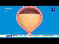 TOPIC What Can Be Done To Maintain Bladder Health