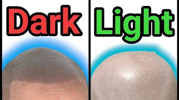Why Dark SMP will become botched SMP | Scalp Micropigmentation