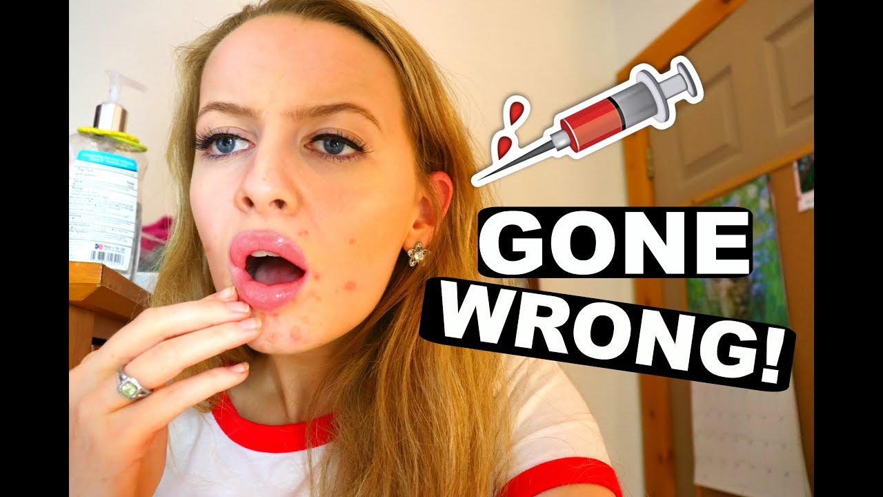 Lip Pumper GONE WRONG! YouTube
