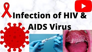 HIV\/AIDs - signs, symptoms, transmission, causes \& pathology