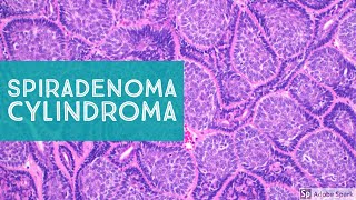 Spiradenoma & Cylindroma...Sweat Gland Tumor Pathology