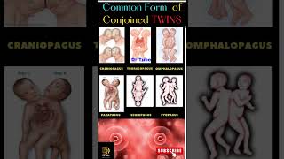 Common forms of conjoined twins ??  Twins  - Birth defects in Twins shortsfeed pregnancy twins