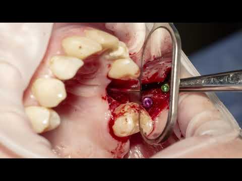 Wideo: Naukowcy: Człowiek To Jego Implanty! - Alternatywny Widok